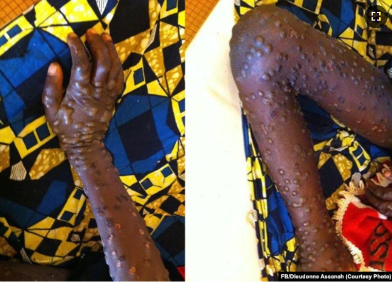 Indonesia Has Not Implemented Quarantine for Immigrants from Countries with Monkeypox